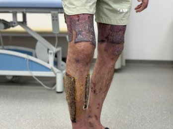 Смалив кабана до свят: львівські лікарі пересадили шкіру чоловіку з опіками половини тіла – 02