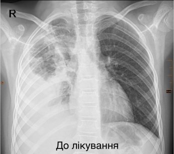 Львівські хірурги врятували 7-річну дівчинку з важкою деструктивною пневмонією – 01