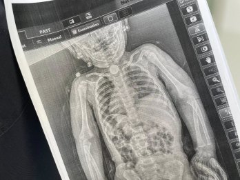 Хірурги Львова врятували дитину, яка три місяці жила з батарейкою у стравоході – 01