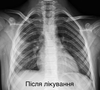 Львівські хірурги врятували 7-річну дівчинку з важкою деструктивною пневмонією – 02