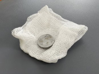 Хірурги Львова врятували дитину, яка три місяці жила з батарейкою у стравоході – 02