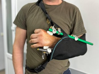 На Львівщині лікарі врятували руку чоловіку, яку він відрізав бензопилою – 04