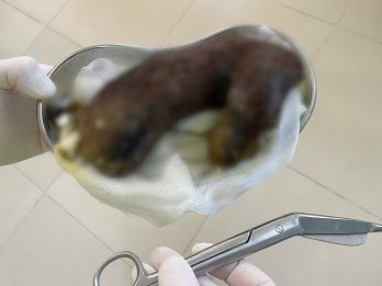 Львівські медики видалили зі шлунка дитини 35-сантиметровий клубок волосся – 02