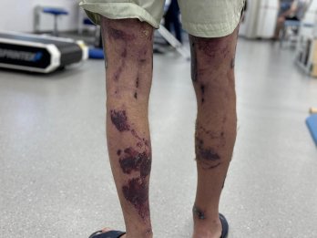 Смалив кабана до свят: львівські лікарі пересадили шкіру чоловіку з опіками половини тіла – 03