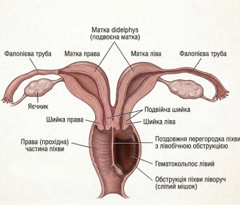 Львівські медики виявили у 15-річної дівчини рідкісну патологію через сильний біль під час менструацій – 02