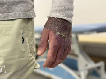 Смалив кабана до свят: львівські лікарі пересадили шкіру чоловіку з опіками половини тіла – 01