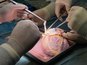 Пересадили серця, нирки та печінку: львівські лікарі провели дев’ять трансплантацій за короткий час – 05