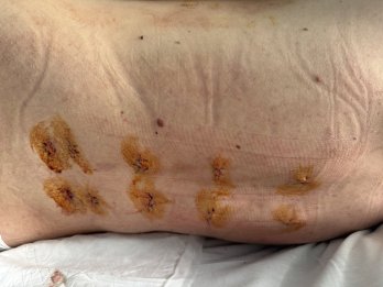 Медики Дрогобича врятували 21-річного мотоцикліста з важкою травмою хребта після ДТП – 02