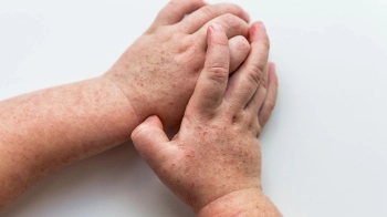 Через скарлатину до інфекційної лікарні потрапили двоє вихованців львівського дитсадка