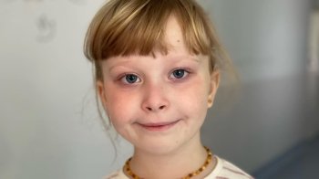 Львівські медики видалили 5-річній дівчинці з легенів величезний гнійник