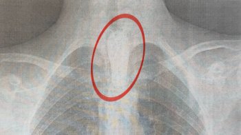 У Львові прооперували дитину, яка ледь не подавилася шматком шашлика