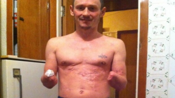 Для оформлення документів потрібні відбитки пальців, а рук немає: бойовик «ДНР» помер у злиднях