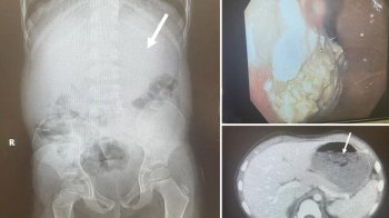 5-річний хлопчик проковтнув 40 жуйок: чи загрожувало це його життю