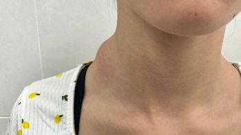 На Львівщині побільшало звернень щодо запалення лімфовузлів у дітей