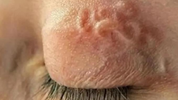 З ока львів’янина лікарі витягнули 11-сантиметрового гельмінта