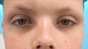 Під час риболовлі на Львівщині гачок застряг в оці 12-річного хлопчика