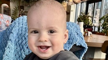 Львівські лікарі вкоротили язик єдиному в Україні немовляті з рідкісним синдромом