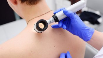 На Львівщині значно збільшилась кількість виявлених злоякісних утворів на шкірі