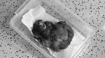 Медики видалили львів’янці злоякісну пухлину вагою 5 кг