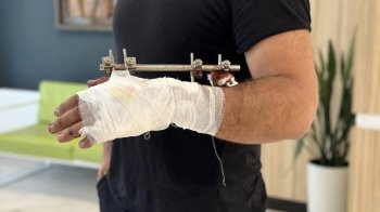 У Львові хірурги врятували руку чоловіка, розчавлену пресом