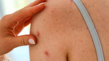 До львівської лікарні у тяжкому стані госпіталізували 30-річну жінку з кором