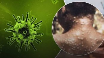 Всесвітня мережа охорони здоров’я оголосила мавпячу віспу пандемією