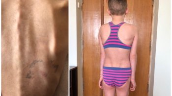 У Львові лікарі врятували 12-річну дівчинку з анорексією