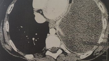 У Львові врятували хлопчика, який 10 років прожив із величезною кістою в легені