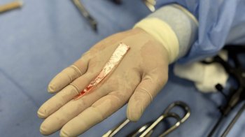 Після атаки дронів у Львові чоловіку витягли 10-сантиметровий уламок із легені