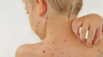 Якщо мавпяча віспа почне поширюватися в дитячих установах, її буде важко стримати, — ВООЗ