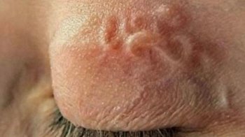 З ока львів’янина хірурги видалили 12-сантиметрового паразита