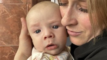 У Львові лікарі врятували малюка зі зрощенням носових отворів