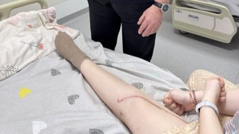 Львівські ортопеди зберегли ногу 16-річній дівчину з агресивною формою раку