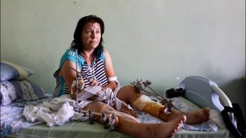 Львівські лікарі рятують ногу жінці, яка опинилася під завалами після вибуху ракети