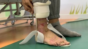 Хлопець отримав опіки 42% шкіри