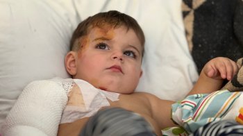 У Львові лікарі врятували півторарічного хлопчика з глибокими опіками