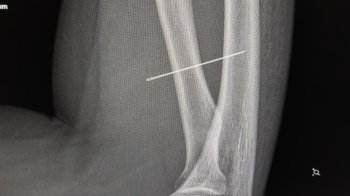 Школярка з Львівщини тиждень ходила з голкою, яку випадково загнала в руку