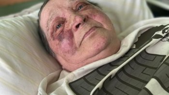 Побили росіяни, бо не хотіла віддавати український паспорт: львівські лікарі врятували літню херсонку