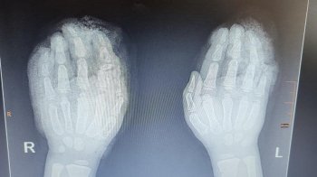 Львівські лікарі «збирали» пальці дитини після травми в січкарні