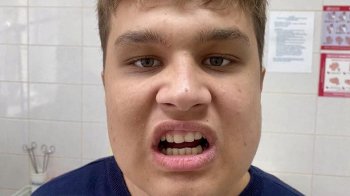 Львівські лікарі прооперували 15-річного хлопця, який не міг відкрити рот через рідкісну хворобу