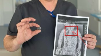 Хірурги Львова врятували дитину, яка три місяці жила з батарейкою у стравоході