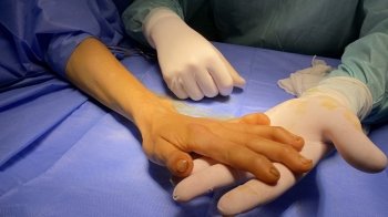 Усе життя ховала руки від чужих очей: львівські лікарі прооперували жінку із рідкісною патологією