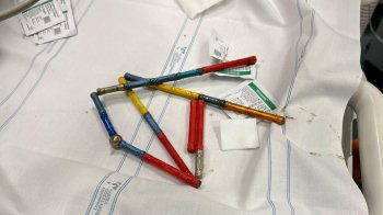 У Києві лікарі прооперували хлопчика, який проковтнув 20 магнітів