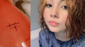 "Наче хтось ллє бензин на тіло і підпалює": як живе дівчина, у якої алергія на воду, піт та сльози