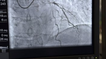 В Університетській лікарні Львова врятували життя пацієнту завдяки безкоштовному стентуванню