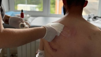 Львівські лікарі виконали складну реконструкцію лопатки