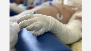 7-річного львів'янина, який постраждав від теракту у Вінниці, лікуватимуть за кордоном