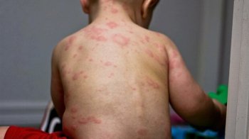 У Львові 2-річний хлопчик перебуває у реанімації з менінгококовою інфекцією