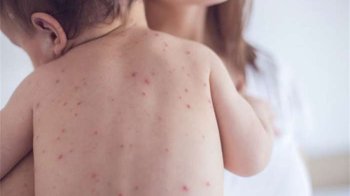 Медики прогнозують на Львівщині спалах кору: що варто знати