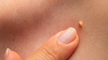 вірус папіломи